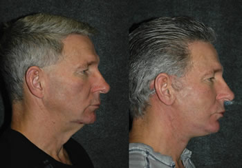 Male Face Lift - Male Plastic Surgery - Patient 3